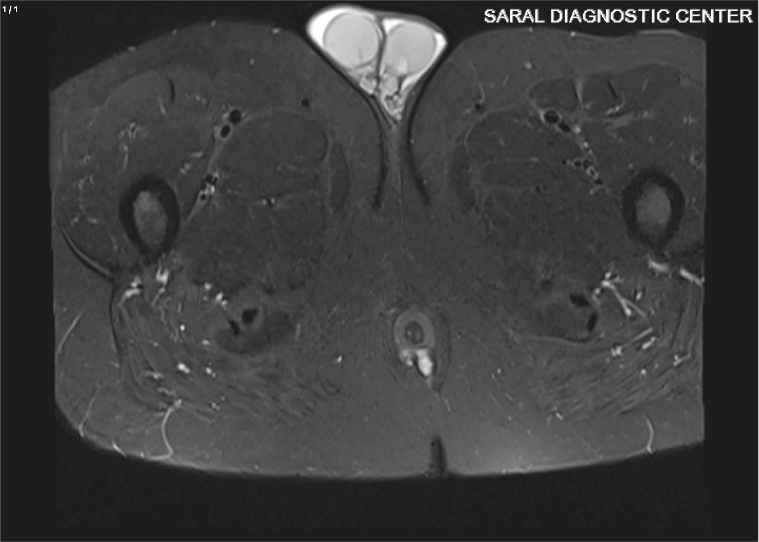 Fistulogram
