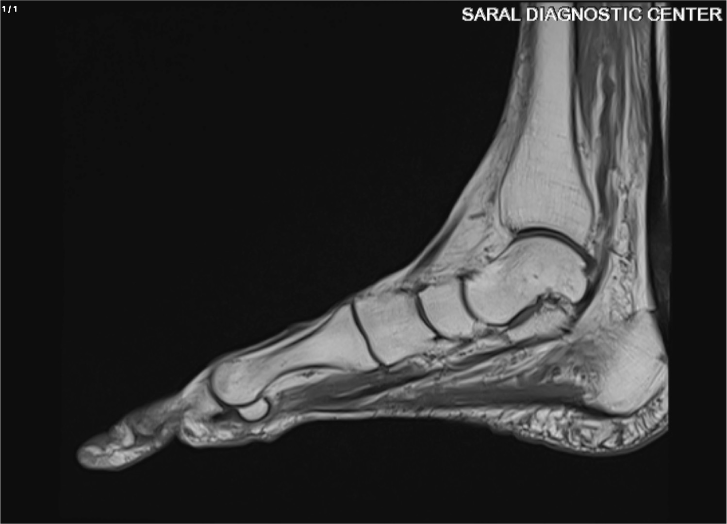Foot (Rt) Plain