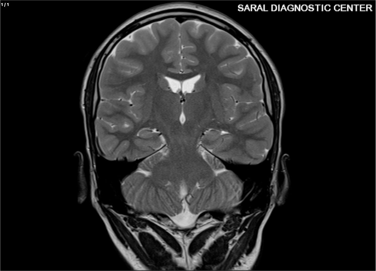Brain (Epilepsy Protocol) + MRA Brain