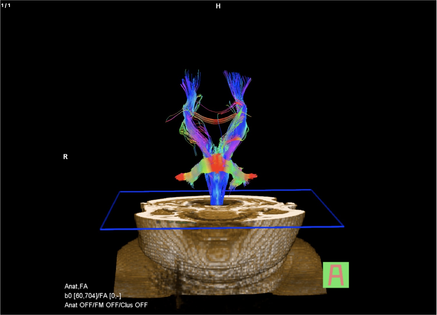 Brain with Tractography (DTI - Diffusion Tensor Imaging)