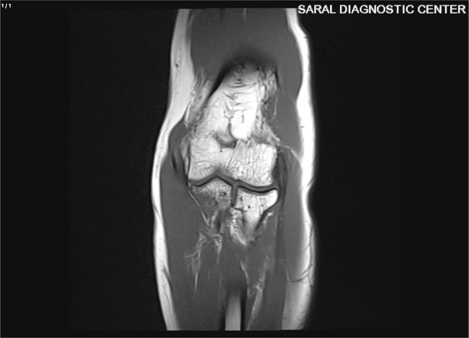 Left Elbow with contrast