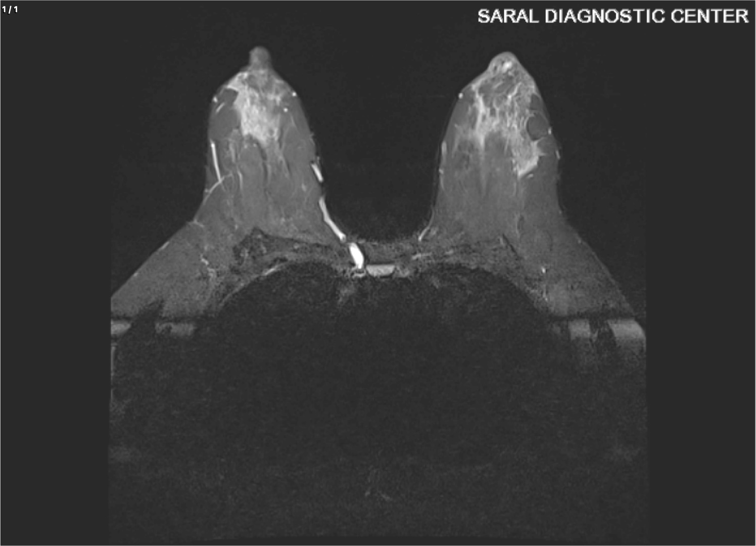 Breast / Mammography (Plain)