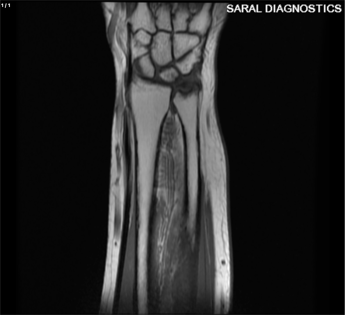 Forearm (Lt)