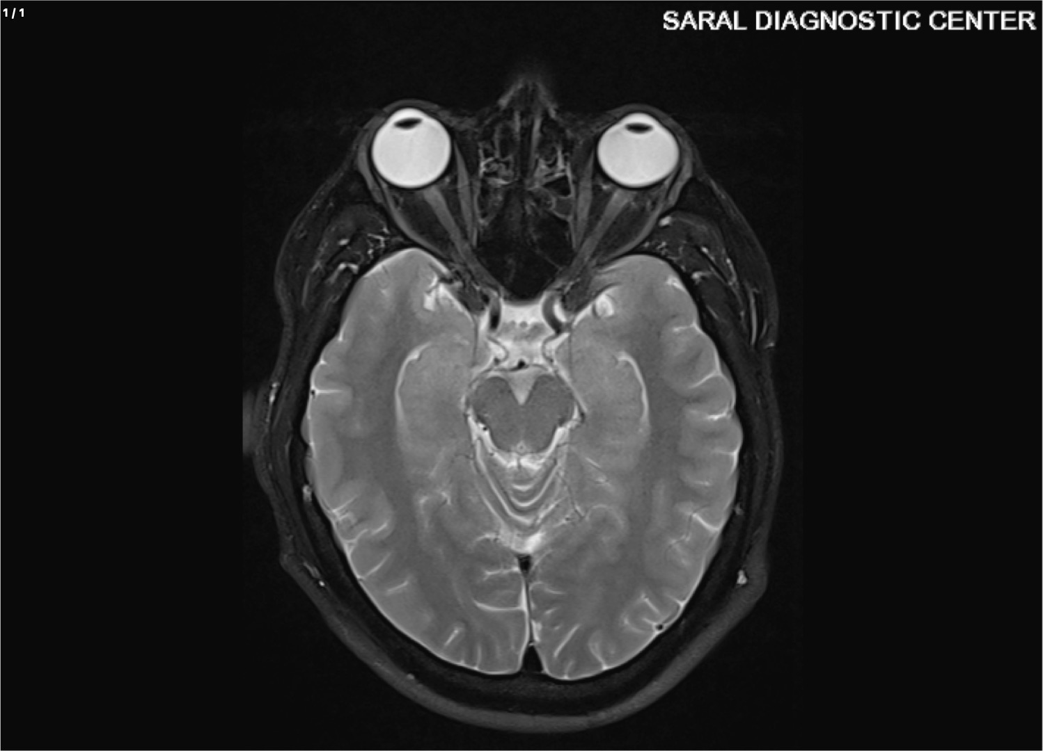 Brain with cavernous sinus
