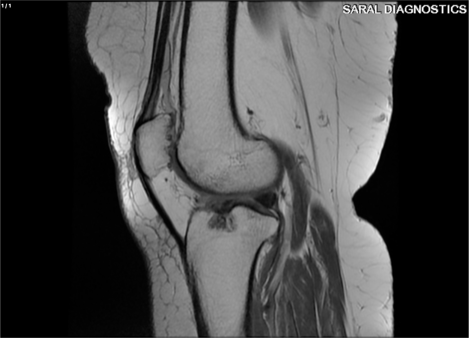 Knee Right with lower thigh