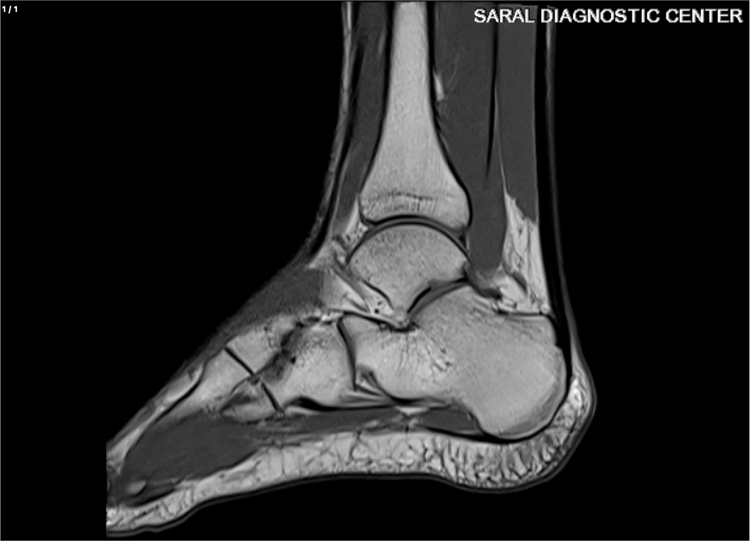 Ankle joint (Rt) Contrast