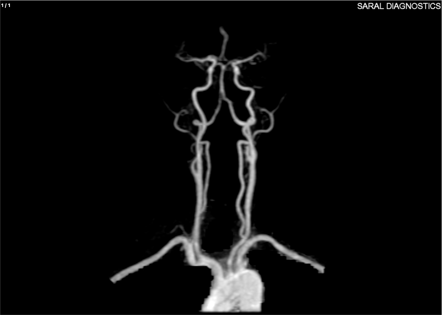 Angio Brain & Neck