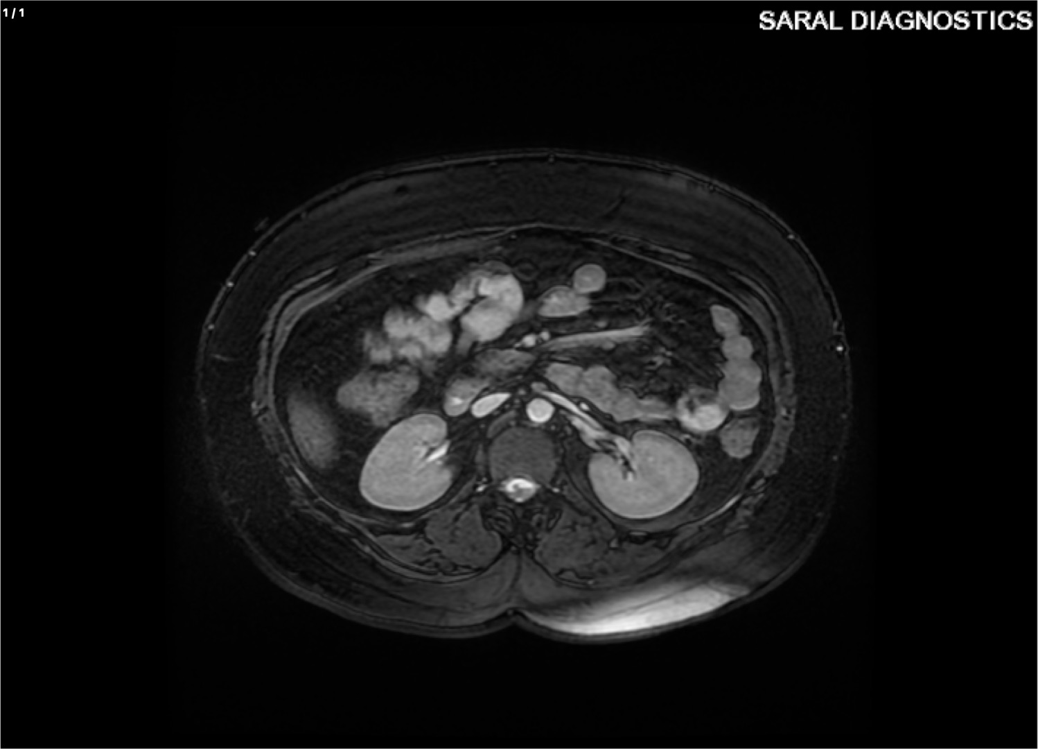 ANGIOGRAPHY RENAL WITH CONTRAST