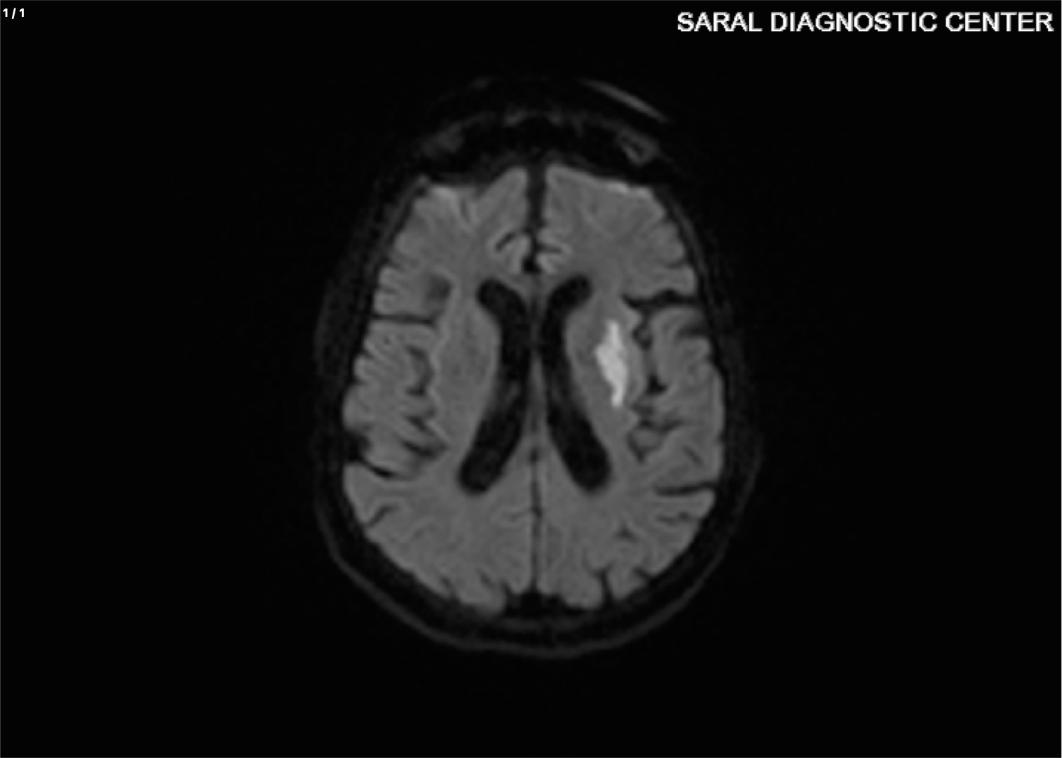 BRAIN WITH DWI (ADC)