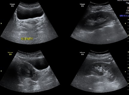 KUB + Lower Abdomen