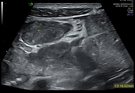 Ultrasound Guided interventional Diagnostic FNAC (Procedure Charges Only)