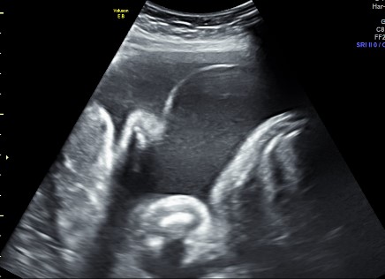 Obstetric  (Twins)