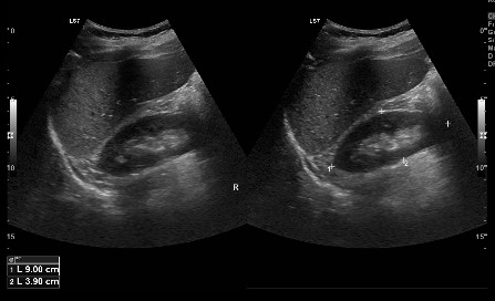 Upper Abdomen