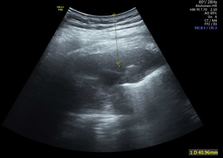 Ultrasound Guided Diagnostic Fluid Tap ( Procedure Charges Only)