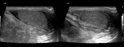 TESTIS (Scrotum)