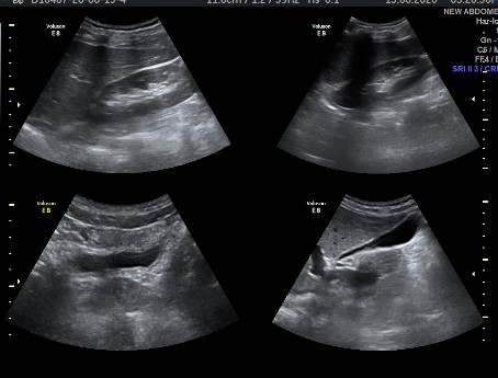 Whole Abdomen (Abdomen and Pelvis)