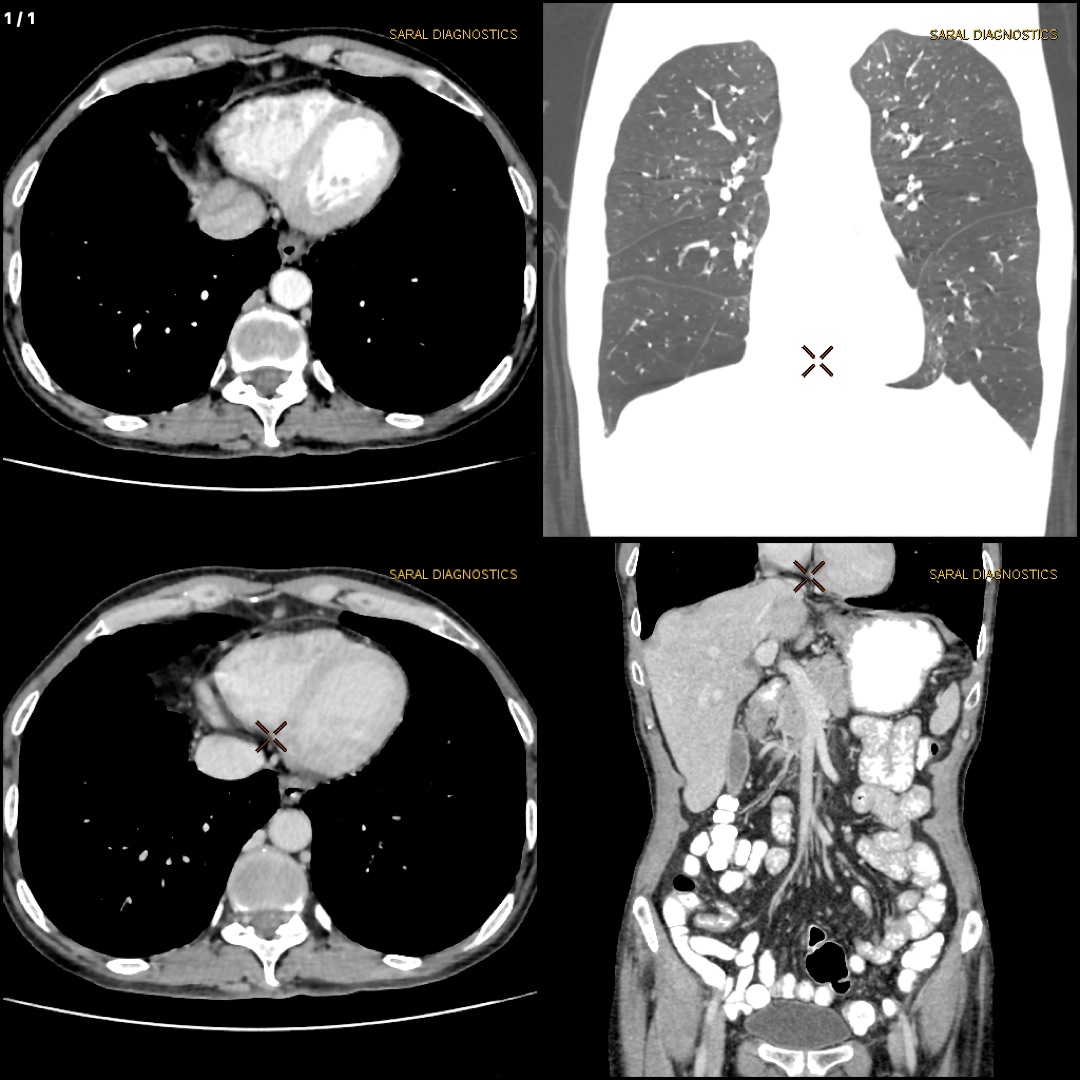 Abdomen Upper With Lower Chest (Scan charges only)