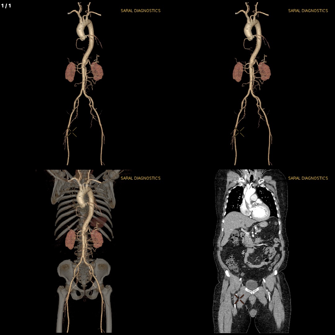 TAVR Protocol (Scan charges only)