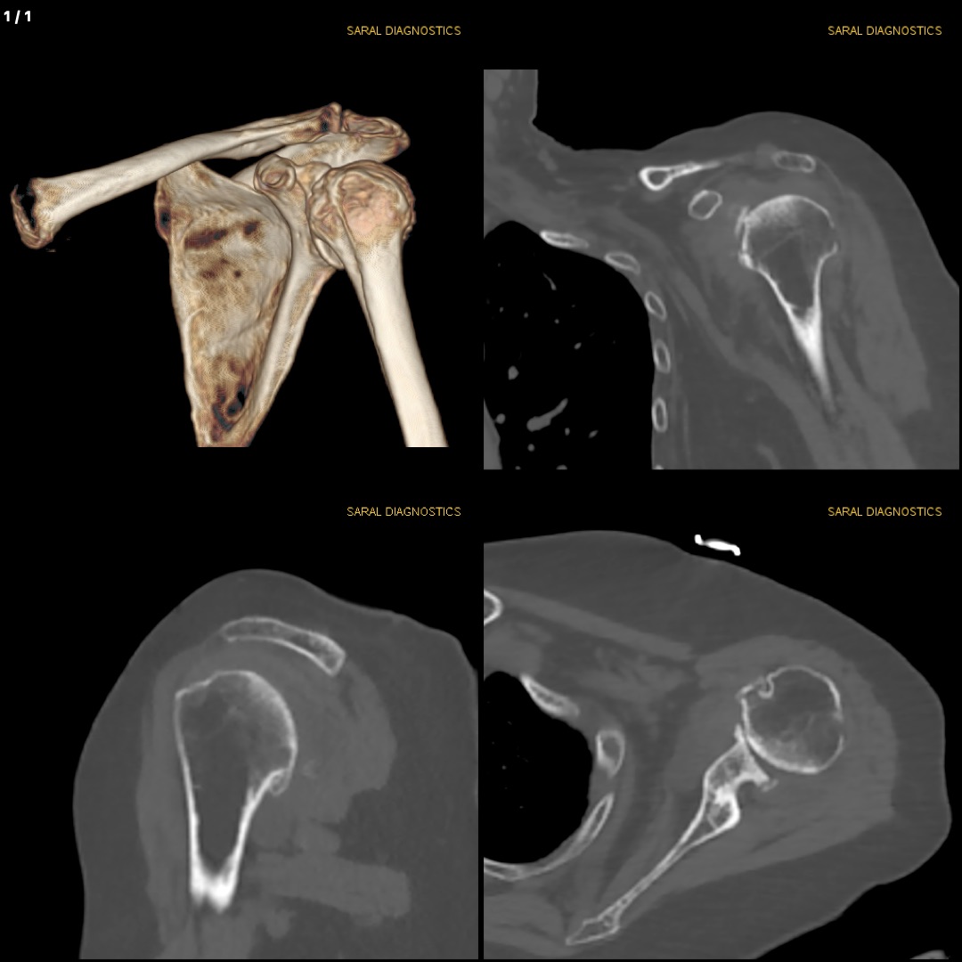 Screening Left Shoulder