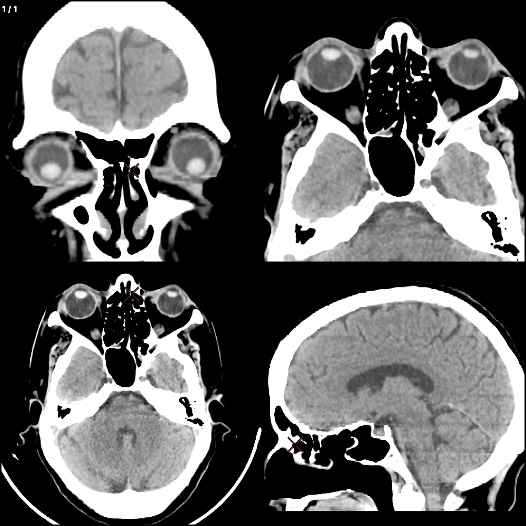 Head With Limited Study Of Orbits Plain
