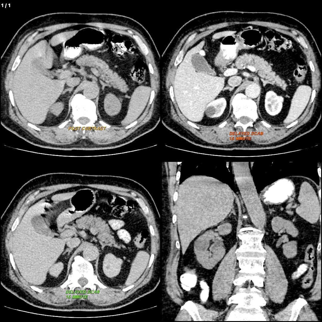 Abdomen Whole With Adrenals Protocol (scan charges only)
